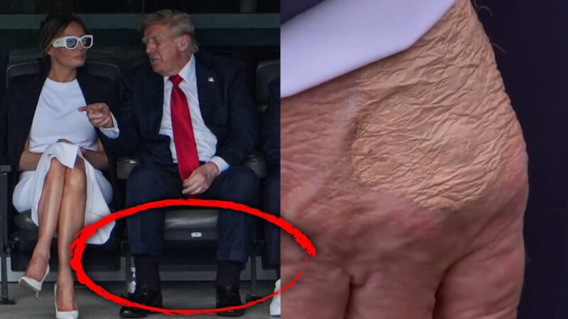 What Is That Spot on President Trump’s Hand?