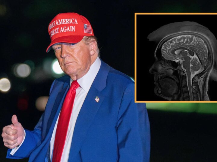 MRI Confirms President Donald Trump Has Incurable Advanced-Stage Patriotism